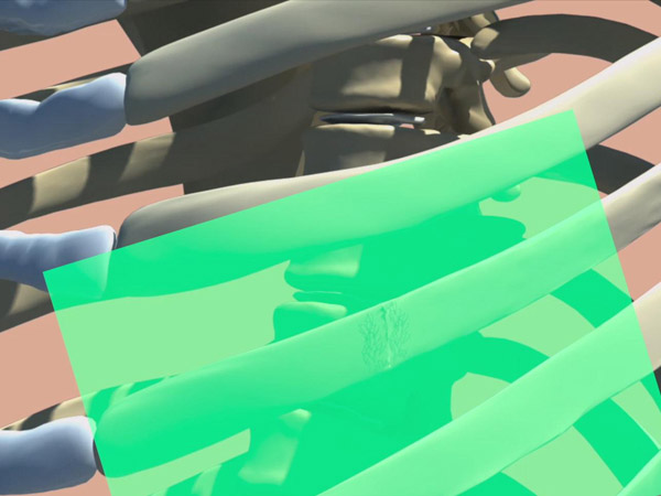 1534303383609447.jpg rib-splint.jpg